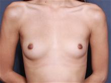Breast Augmentation Before Photo by John Smoot, MD; La Jolla, CA - Case 27660