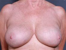Breast Augmentation After Photo by John Smoot, MD; La Jolla, CA - Case 27676