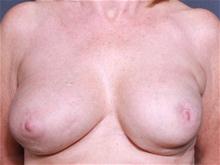 Breast Augmentation Before Photo by John Smoot, MD; La Jolla, CA - Case 27676