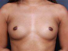 Breast Augmentation Before Photo by John Smoot, MD; La Jolla, CA - Case 27701