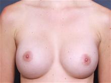Breast Augmentation After Photo by John Smoot, MD; La Jolla, CA - Case 27707