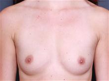 Breast Augmentation Before Photo by John Smoot, MD; La Jolla, CA - Case 27707
