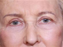Eyelid Surgery After Photo by John Smoot, MD; La Jolla, CA - Case 27708