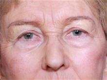 Eyelid Surgery Before Photo by John Smoot, MD; La Jolla, CA - Case 27708