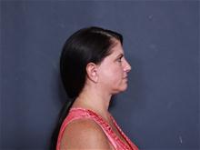 Facelift After Photo by John Smoot, MD; La Jolla, CA - Case 27714
