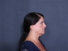 Facelift Before Photo by John Smoot, MD; La Jolla, CA - Case 27714