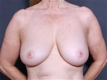 Breast Lift Before Photo by John Smoot, MD; La Jolla, CA - Case 27828