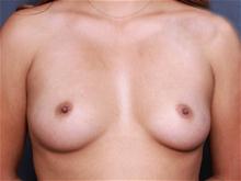 Breast Augmentation Before Photo by John Smoot, MD; La Jolla, CA - Case 27829
