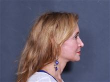 Facelift After Photo by John Smoot, MD; La Jolla, CA - Case 27836