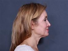 Facelift Before Photo by John Smoot, MD; La Jolla, CA - Case 27836