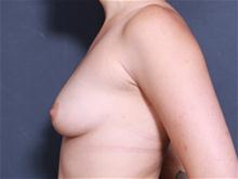 Breast Augmentation Before Photo by John Smoot, MD; La Jolla, CA - Case 27849