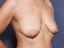 Breast Lift Before Photo by John Smoot, MD; La Jolla, CA - Case 27921