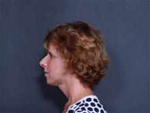 Facelift After Photo by John Smoot, MD; La Jolla, CA - Case 27977
