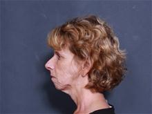 Facelift Before Photo by John Smoot, MD; La Jolla, CA - Case 27977