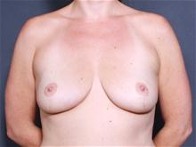 Breast Augmentation Before Photo by John Smoot, MD; La Jolla, CA - Case 28008