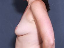 Breast Augmentation Before Photo by John Smoot, MD; La Jolla, CA - Case 28008