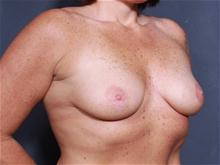 Breast Augmentation Before Photo by John Smoot, MD; La Jolla, CA - Case 28037