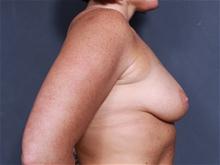 Breast Augmentation Before Photo by John Smoot, MD; La Jolla, CA - Case 28037