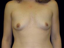 Breast Augmentation Before Photo by Miguel Delgado, M.D.; Novato, CA - Case 28961