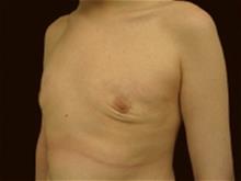 Male Breast Reduction After Photo by Miguel Delgado, M.D.; Novato, CA - Case 28962