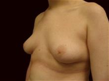 Male Breast Reduction Before Photo by Miguel Delgado, M.D.; Novato, CA - Case 28962