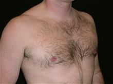 Male Breast Reduction After Photo by Miguel Delgado, M.D.; Novato, CA - Case 28963