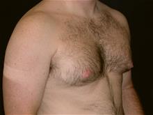 Male Breast Reduction Before Photo by Miguel Delgado, M.D.; Novato, CA - Case 28963