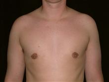 Male Breast Reduction After Photo by Miguel Delgado, M.D.; Novato, CA - Case 28964