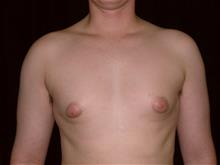 Male Breast Reduction Before Photo by Miguel Delgado, M.D.; Novato, CA - Case 28964