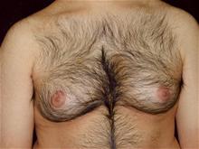Male Breast Reduction Before Photo by Miguel Delgado, M.D.; Novato, CA - Case 28965