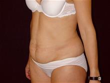 Tummy Tuck Before Photo by Miguel Delgado, M.D.; Novato, CA - Case 28966