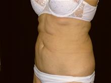 Tummy Tuck Before Photo by Miguel Delgado, M.D.; Novato, CA - Case 28968