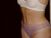 Tummy Tuck After Photo by Miguel Delgado, M.D.; Novato, CA - Case 28970