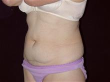 Diastasis Recti Repair and Tummy Tuck Surgery - Miguel Delgado, MD