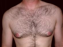 Male Breast Reduction Before Photo by Miguel Delgado, M.D.; Novato, CA - Case 28971