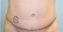 Tummy Tuck After Photo by Scott Tucker, MD; Winston-Salem, NC - Case 38247