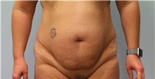Tummy Tuck Before Photo by Scott Tucker, MD; Winston-Salem, NC - Case 38247
