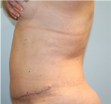 Tummy Tuck After Photo by Scott Tucker, MD; Winston-Salem, NC - Case 38247