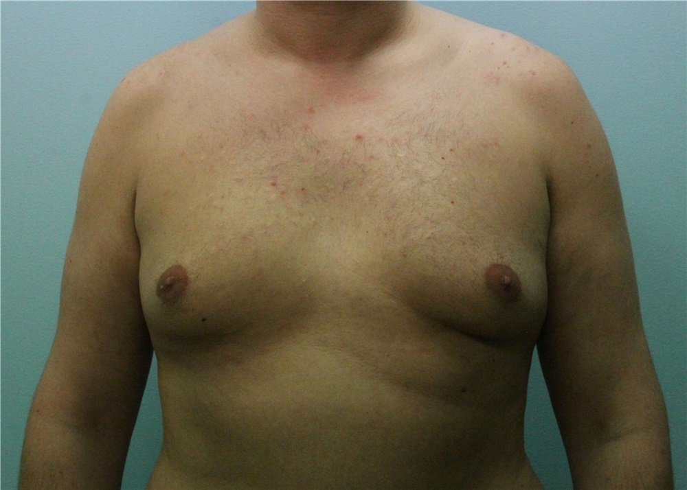 Male Breast Reduction Before and After Photos by Scott Tucker, MD; Winston- Salem, NC - Case 38250