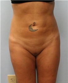 Liposuction After Photo by Scott Tucker, MD; Winston-Salem, NC - Case 38545