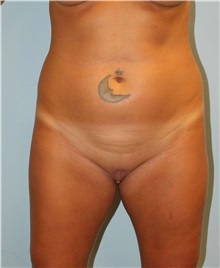Liposuction Before Photo by Scott Tucker, MD; Winston-Salem, NC - Case 38545