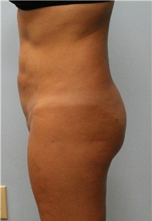 Liposuction After Photo by Scott Tucker, MD; Winston-Salem, NC - Case 38545