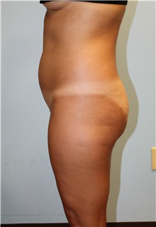 Liposuction Before Photo by Scott Tucker, MD; Winston-Salem, NC - Case 38545