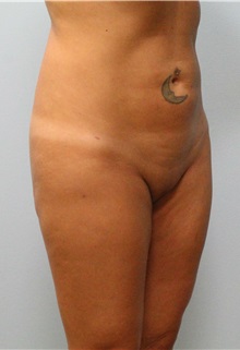 Liposuction After Photo by Scott Tucker, MD; Winston-Salem, NC - Case 38545
