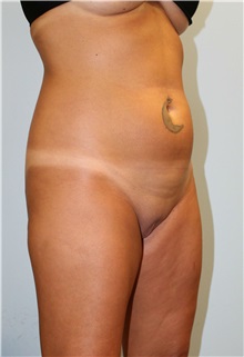 Liposuction Before Photo by Scott Tucker, MD; Winston-Salem, NC - Case 38545