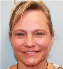 Facelift Before Photo by Scott Tucker, MD; Winston-Salem, NC - Case 38548