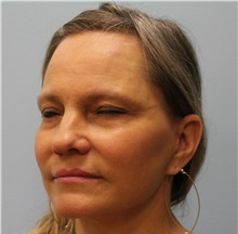 Facelift After Photo by Scott Tucker, MD; Winston-Salem, NC - Case 38548