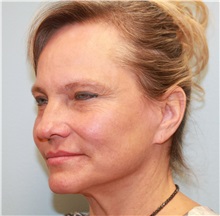 Facelift Before Photo by Scott Tucker, MD; Winston-Salem, NC - Case 38548