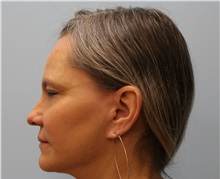 Facelift After Photo by Scott Tucker, MD; Winston-Salem, NC - Case 38548