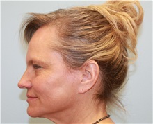 Facelift Before Photo by Scott Tucker, MD; Winston-Salem, NC - Case 38548